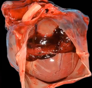 Left Atrial Rupture