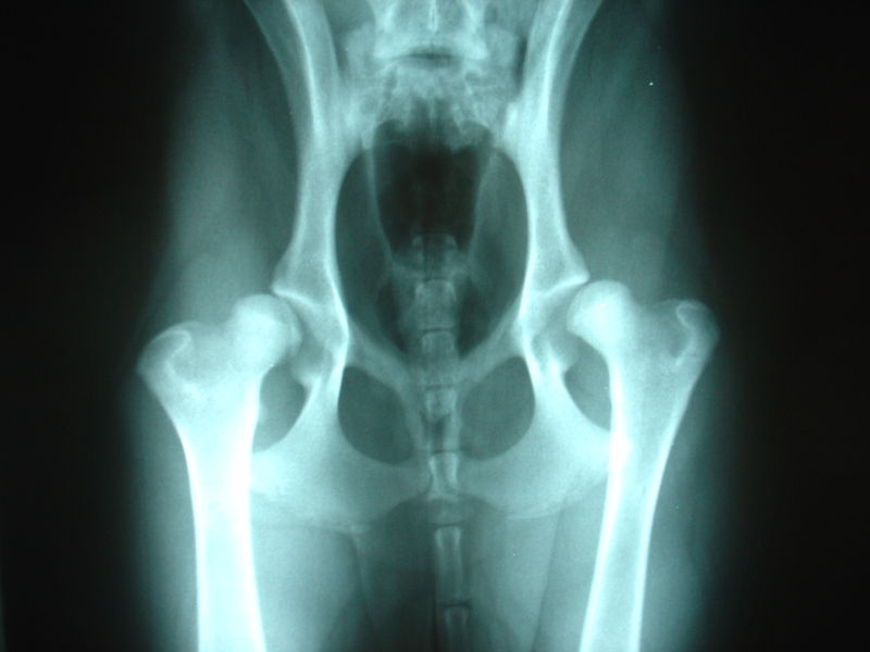 Bilateral Dysplastic Hips