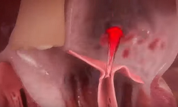 Blood backflowing through mitral valve