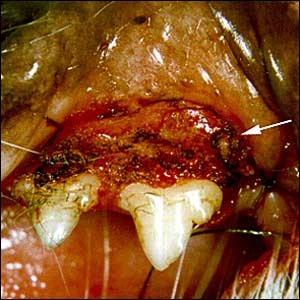 Stomatitis Lesions