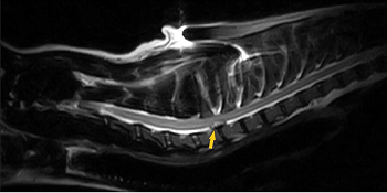 C7-T1 disc extrusion on MRI