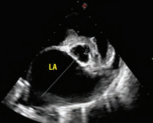 Echo scan of left atrium, severely enlarged