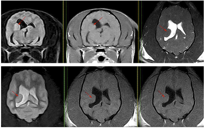 Subependymal neuronal heterotopia 