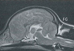 Location of swine fat graft 1 year after duraplasty surgery