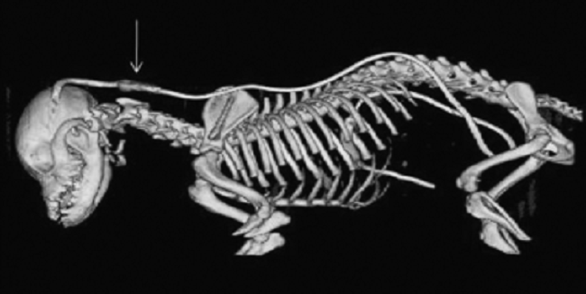 Location of ventriculoperitoneal shunt placement.