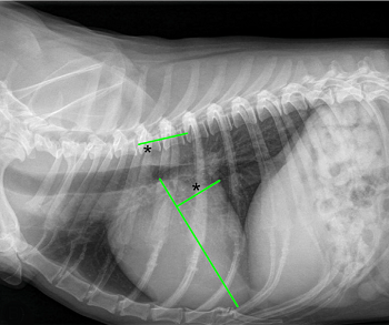 Left Atrial Width