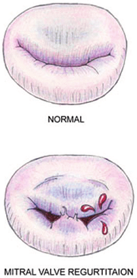 Mitral Valve Diagram