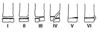 Salter-Harris Classification