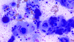 Squamous Cell Carcinoma