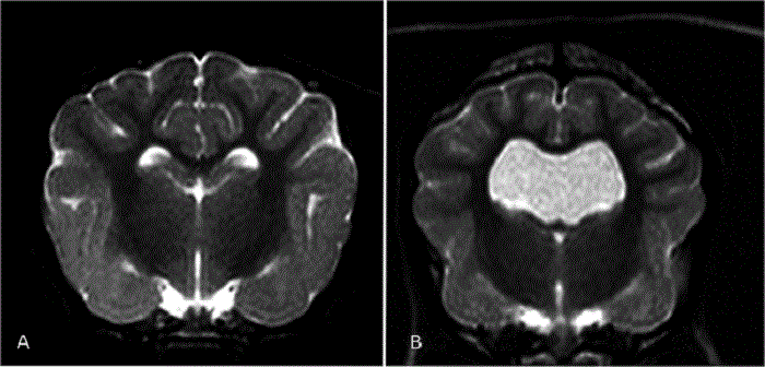 Ventricles: Normal v. Enlarged