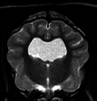 Enlarged Ventricles